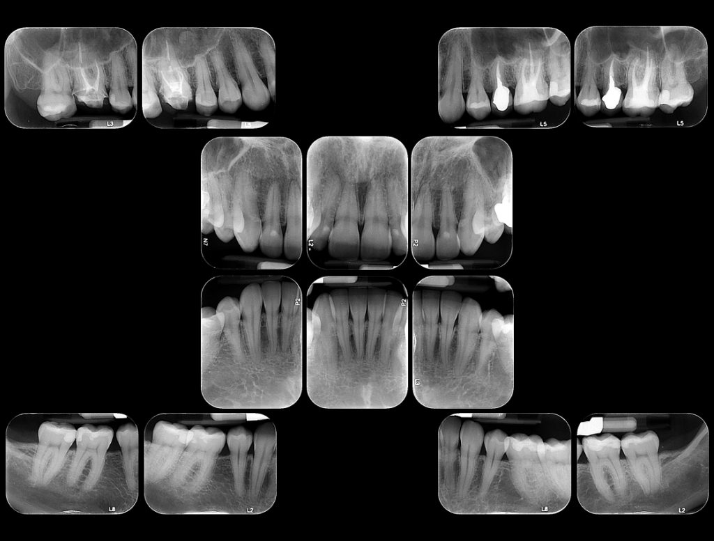 radiografia periapical